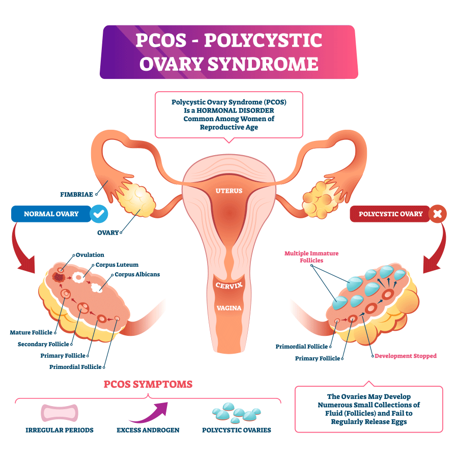 Polycystic-Ovary-Syndrome-diagram